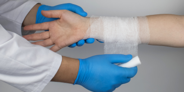 La gestione dell’infermiere nel trattamento del paziente ustionato: Un approfondimento sulle scale di valutazione