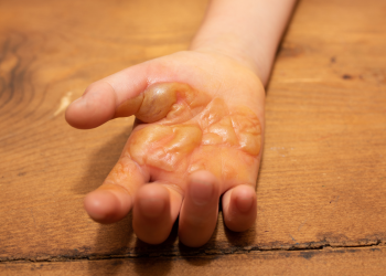 Gestione delle ustioni: ruolo dell’infermiere e valutazione