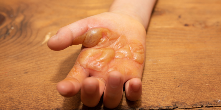 Gestione delle ustioni: ruolo dell’infermiere e valutazione