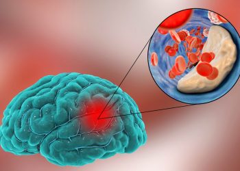 Trombosi farmacologica in paziente con ictus ischemico