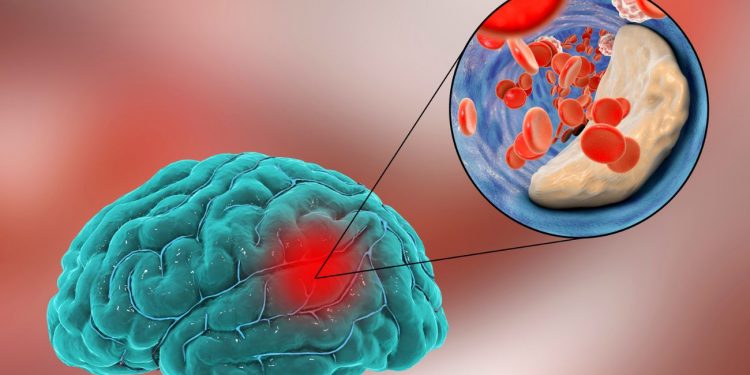 Trombosi farmacologica in paziente con ictus ischemico